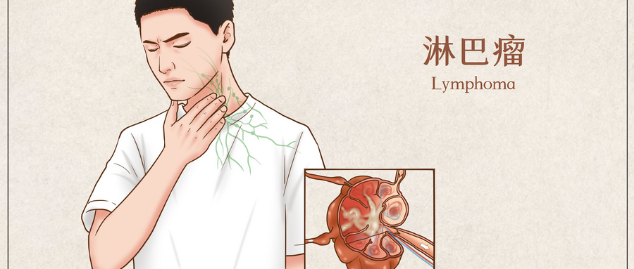 淋巴瘤.jpg 淋巴瘤.jpg