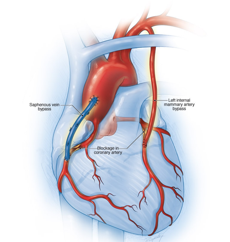 冠状动脉搭桥手术