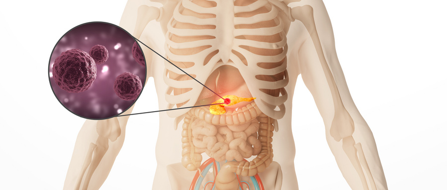 英国就医治疗胰腺癌指南