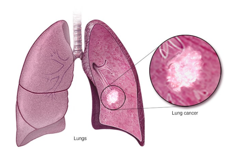 肺癌的症状与病因