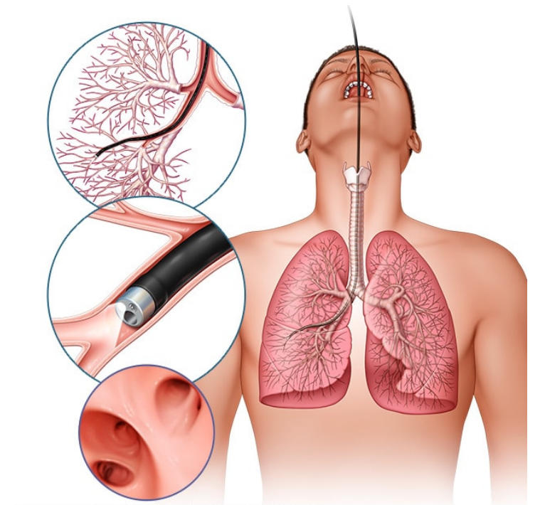 肺癌的诊断-支气管镜