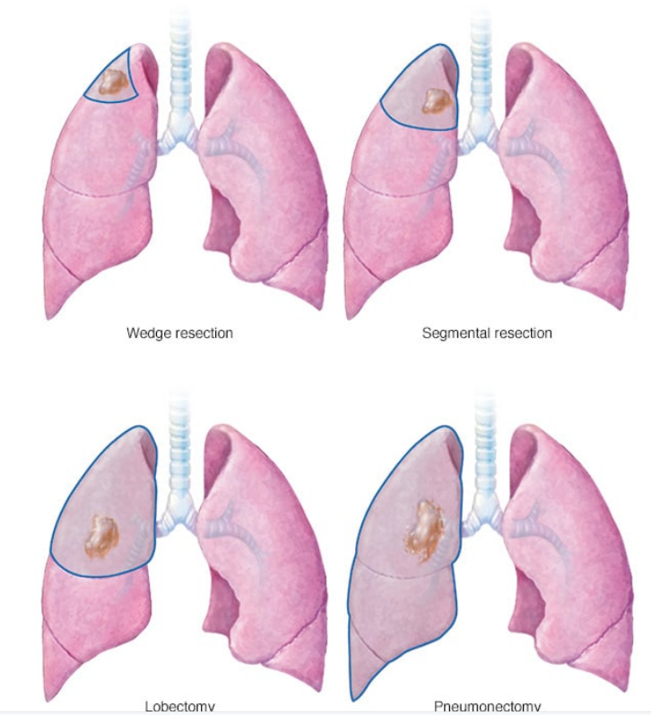 肺癌的手术类型