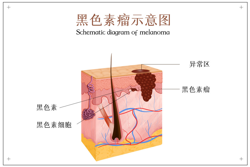 美国治疗黑色素瘤