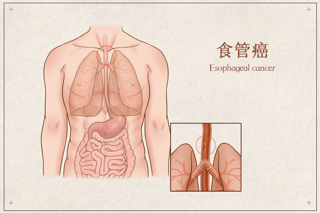 食管癌国外治疗方案