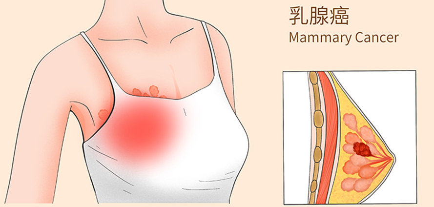 乳腺癌日本就医