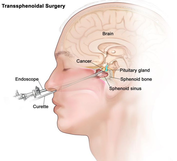 经蝶窦手术；图中显示内窥镜和刮匙通过鼻腔和蝶窦插入以切除垂体中的癌细胞。图中还显示了蝶骨。