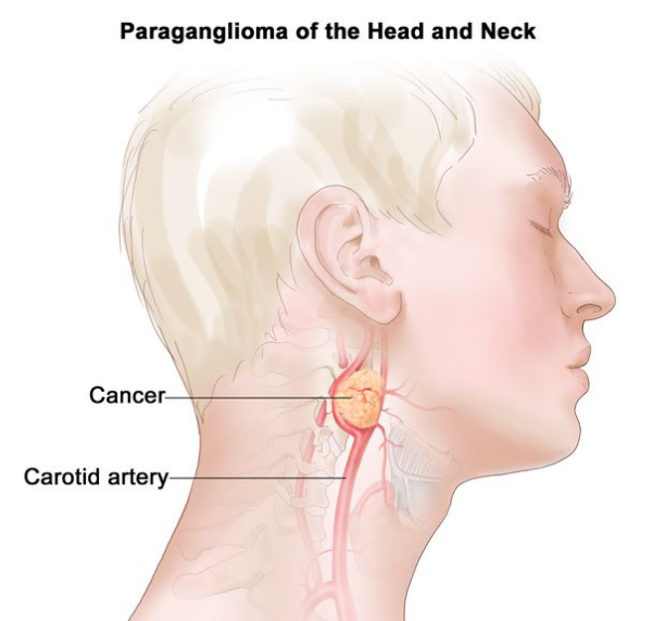 头颈部副神经节瘤；图中显示头颈部颈动脉附近的肿瘤。