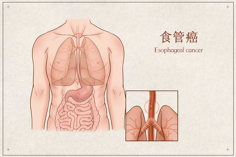 美国食管癌治疗药物列表