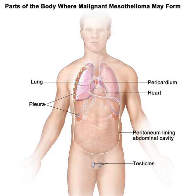 图中显示了可能形成恶性间皮瘤的身体部位，包括胸膜（衬在胸腔内并覆盖肺部的组织）、心包（围绕心脏的组织）、腹膜（衬在腹部并覆盖腹部大部分器官的组织）和睾丸。图中还显示了心脏和肺部。