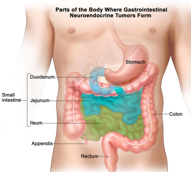 胃肠道神经内分泌肿瘤是在胃肠道内壁形成的癌症。