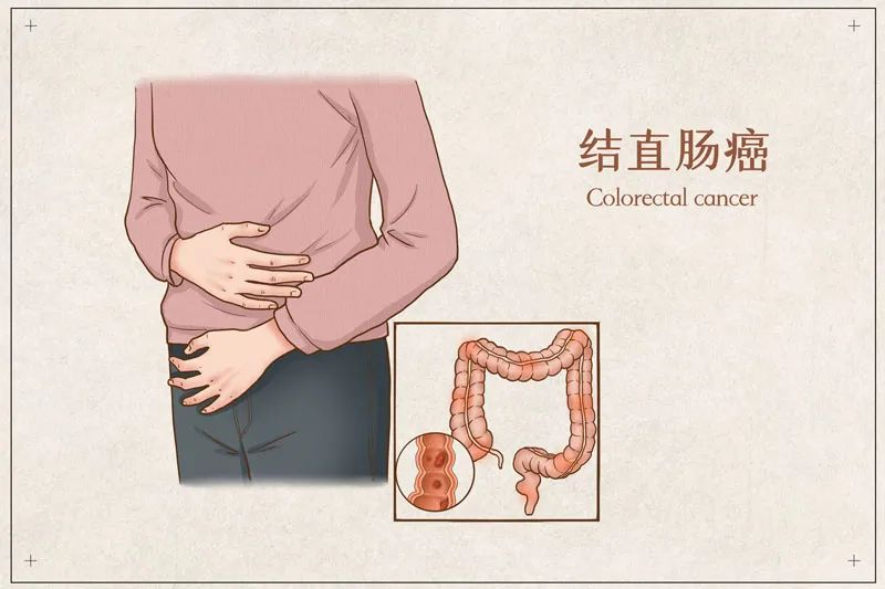 日本结直肠癌手术的优势与治疗生存率