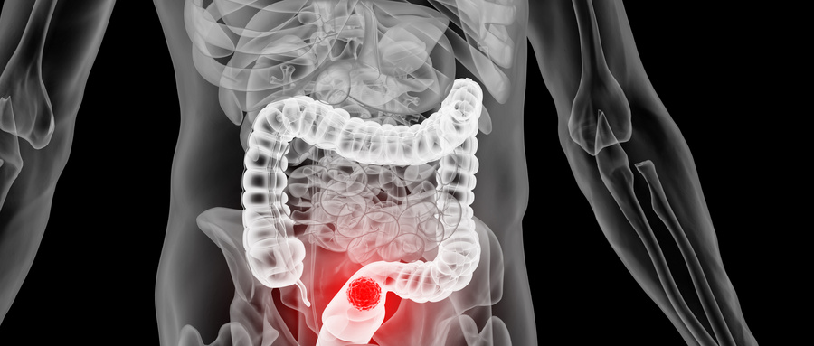 直肠癌患者赴日就医指南