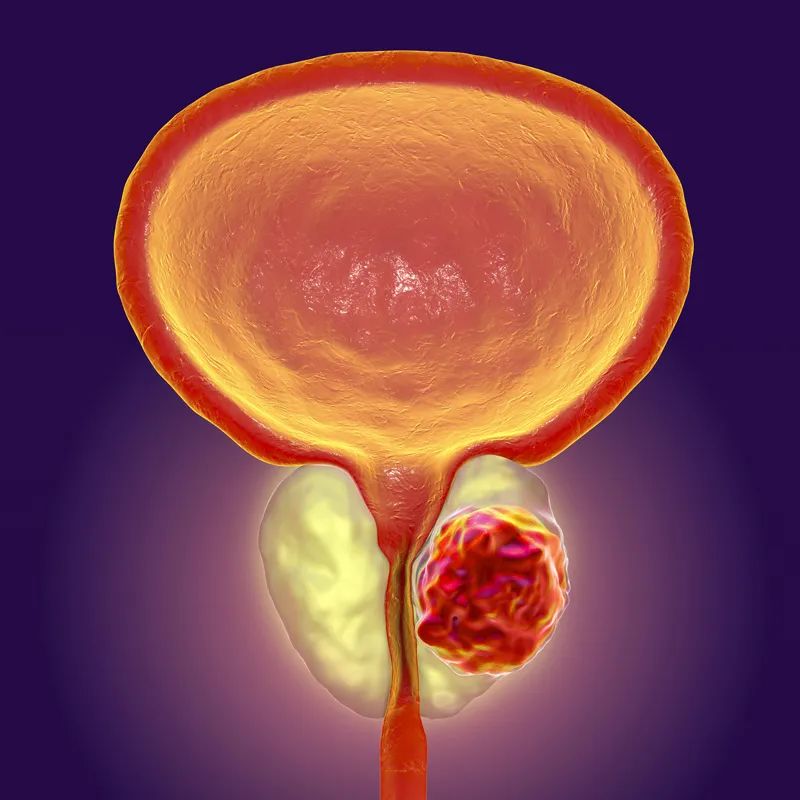 前列腺癌美国治疗前沿进展与中介机构选择指南