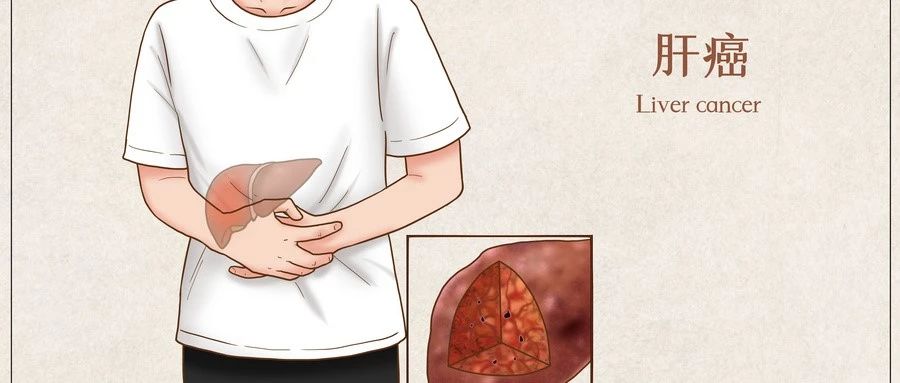 超声波组织碎化术（Histotripsy）：突破性肝癌治疗技术