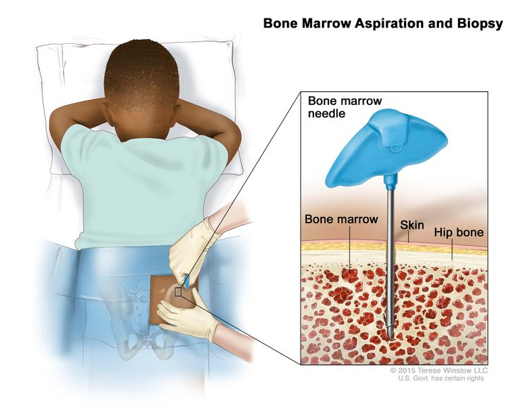 放大骨髓穿刺和活检；图画显示一名儿童面朝下躺在桌子上，一根骨髓针插入其右髋骨。插图显示骨髓针穿过皮肤插入髋骨骨髓。