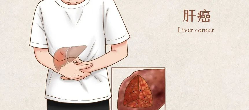 肝癌出国治疗费用全解析:主流国家疗法差异与省钱指南 肝癌出国治疗费用全解析:主流国家疗法差异与省钱指南