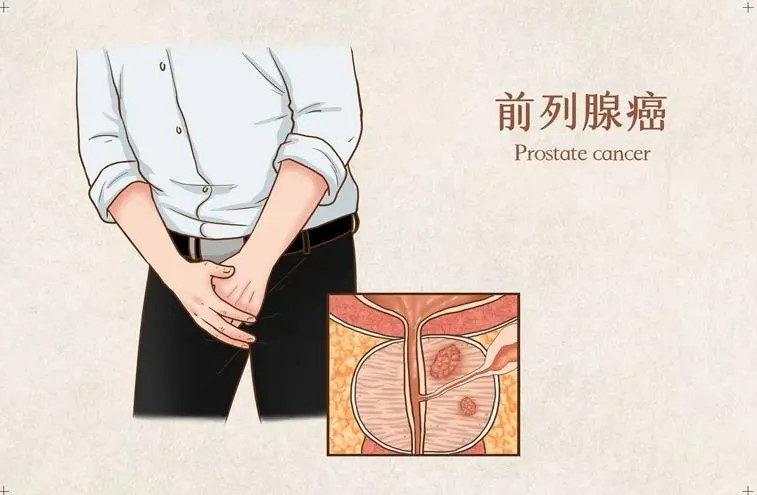 前列腺癌适合质子治疗吗？出国就医全流程与医院筛选指南