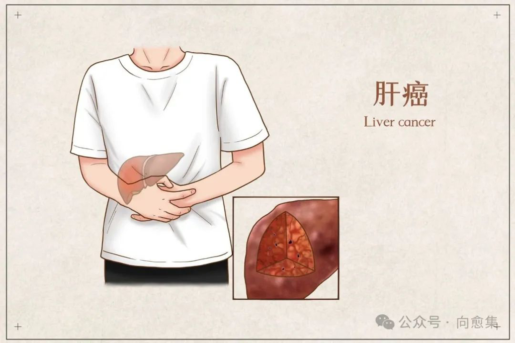 肝癌 肝癌