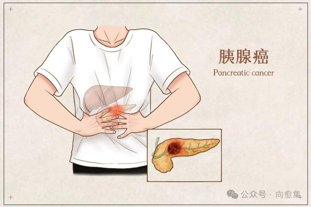 胰腺癌新药 胰腺癌新药