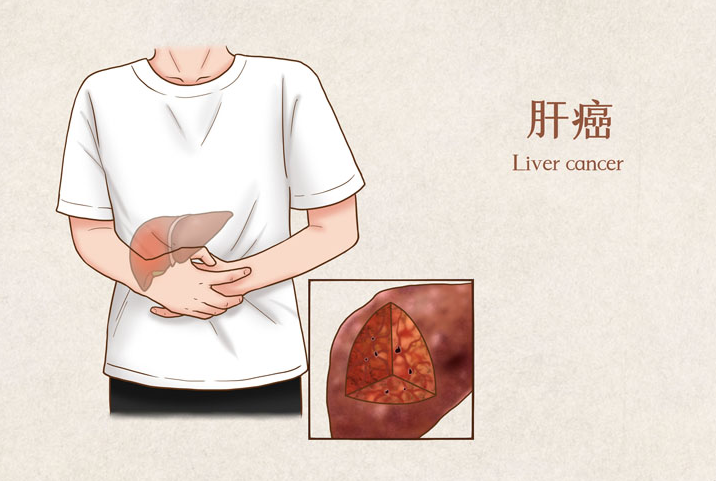 肝癌出国就医如何选择医院和中介机构