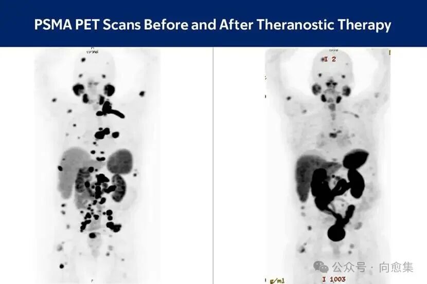 前列腺癌患者的 PSMA PET 扫描。