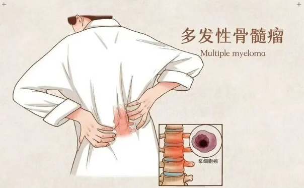 多发性骨髓瘤