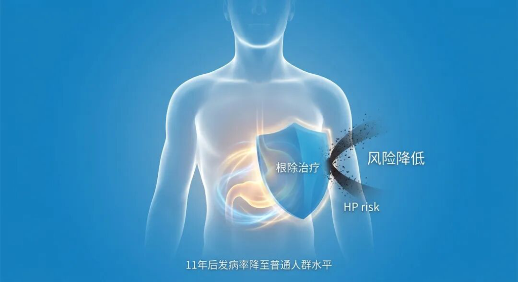 一张温暖且专业的医学插画:一个抽象的发光人体轮廓,胃部受到蓝色“根除治疗”能量盾牌的保护,将外界风险挡在外面。画面配有中文标签“风险降低”及数据说明“11年后发病率降至普通人群水平”,传递出医学干预带来的安全感与希望。