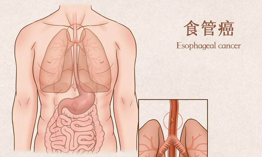 胃癌、食管癌赴美就医选哪家医院?2026年美国癌症与胃肠外科排名交叉分析 胃癌、食管癌赴美就医选哪家医院?2026年美国癌症与胃肠外科排名交叉分析