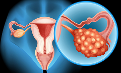 ​新研究结果证实：这款双特性抗体药物对抗卵巢癌数据出色！