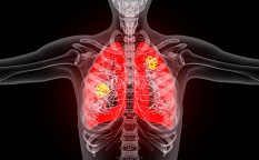 肺癌创新药SRF388临床数据良好，患者病情稳定超56周！