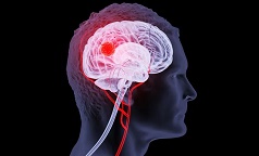 新技术可突破血脑屏障直接治疗脑肿瘤，强效且低毒，值得关注！