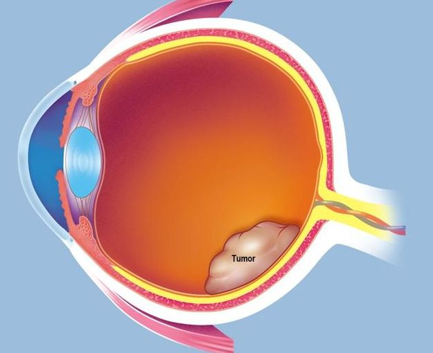 视网膜母细胞瘤的症状有哪些？病因是什么？