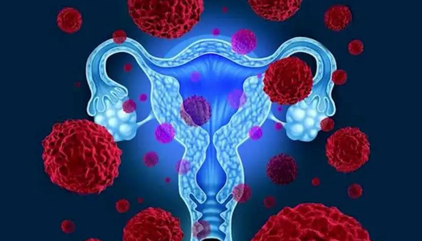 宫颈癌筛查和诊断，如何治疗宫颈癌？