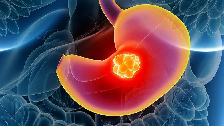 胃癌的病因和症状，如何预防胃癌？