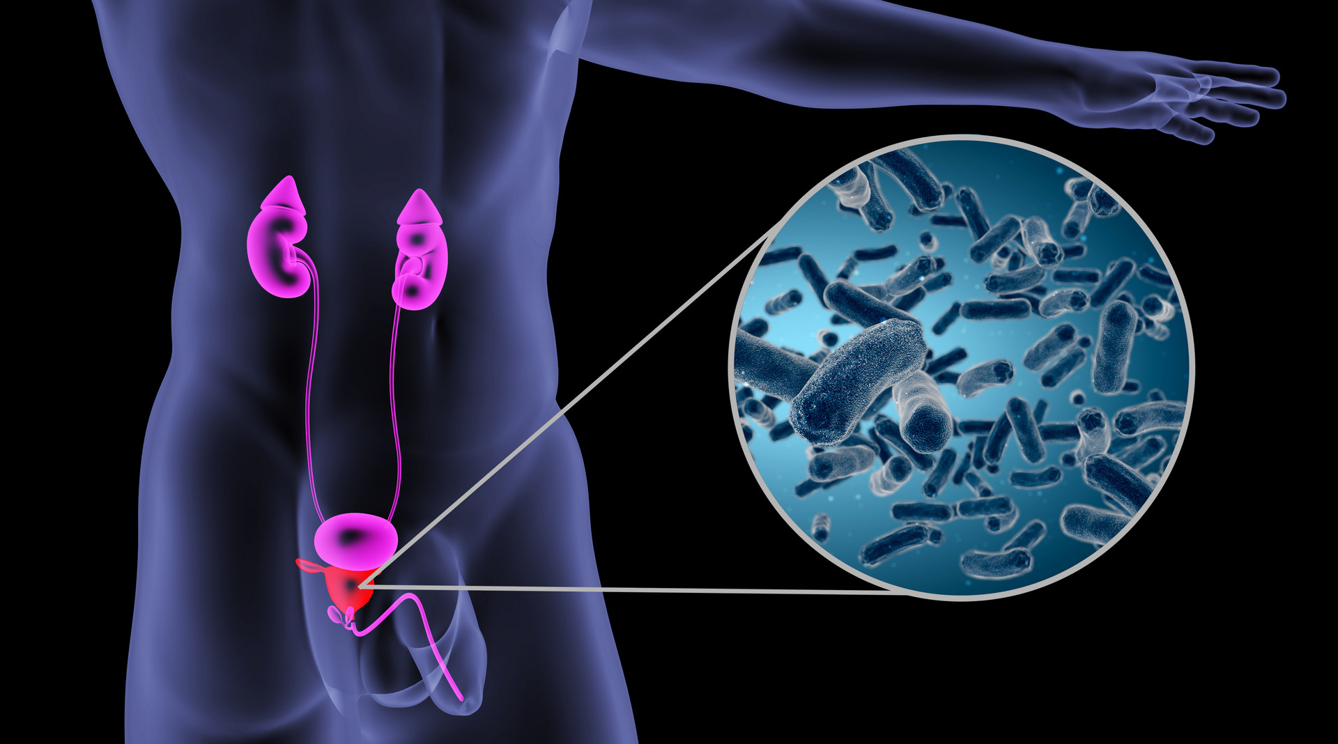 美国膀胱癌治疗：新方法与就医攻略