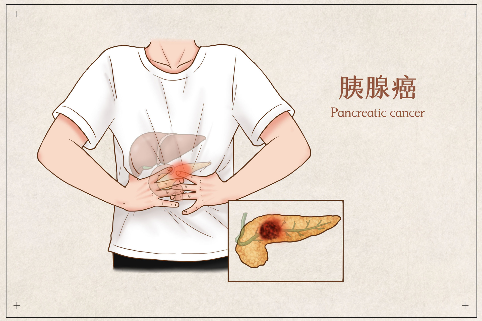 胰腺癌出国治疗方案