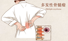 多发性骨髓瘤3药新疗法，让患者生存期实现翻倍！