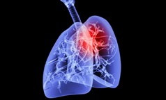 60%患者肿瘤大幅缩小或消失，德国肺癌前沿药BAY 2927088获突破性疗法认定