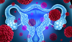 一款美国新药和化疗组成的联合疗法，治疗晚期子宫内膜癌展现巨大潜力
