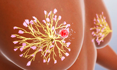 美国专家解读：乳腺癌患者手术前必须做活检吗？会加速转移扩散吗？