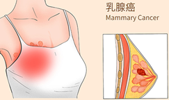 三阴性乳腺癌治疗新突破！帕博利珠单抗联合治疗方案，使86.6%的患者治疗5年后仍存活