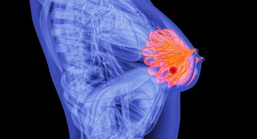 革命性突破！两大明星药联手出击， 三阴性乳腺癌患者有望摆脱复发阴霾？