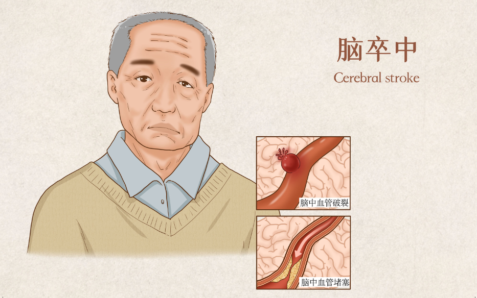 10月23日北京丨芝大医学教授：脑梗、脑溢血有哪些高危信号？如何不错过“黄金治疗机会”？（限时免费报名）