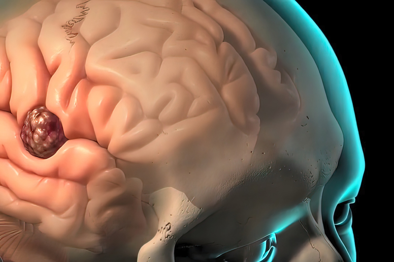 AMXT 1501联合DFMO获孤儿药资格，为神经母细胞瘤患者带来新希望