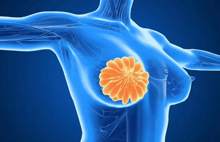 乳腺癌盘点:2025年美国新批准4项重磅疗法,具体适合哪些患者?怎么用?
