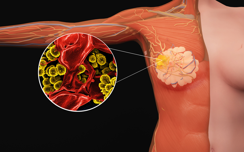 乳腺癌脑转移患者福音：新型CAR-T疗法让64%患者病情维持稳定，安全性良好