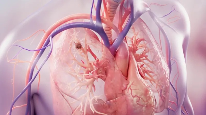 96%患者局部肿瘤被有效控制!Aliya脉冲电场消融技术对多种晚期实体瘤疗效显著