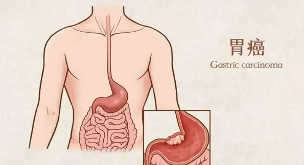 胃癌治疗新突破：美国FDA批准胃癌围手术期新方案，可使肿瘤完全消失率提升2.7倍