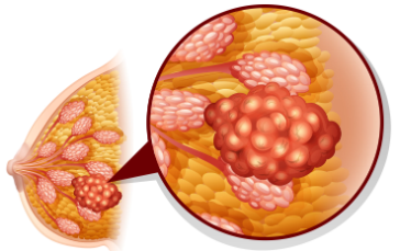 乳腺癌新突破！Zovegalisib方案让六成“双突变”耐药患者肿瘤显著缩小！