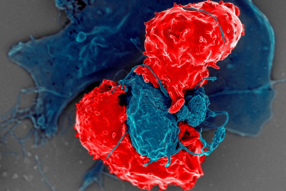 重磅发现:结直肠癌中,一种不被看好的免疫细胞越多,患者反而活得越久!